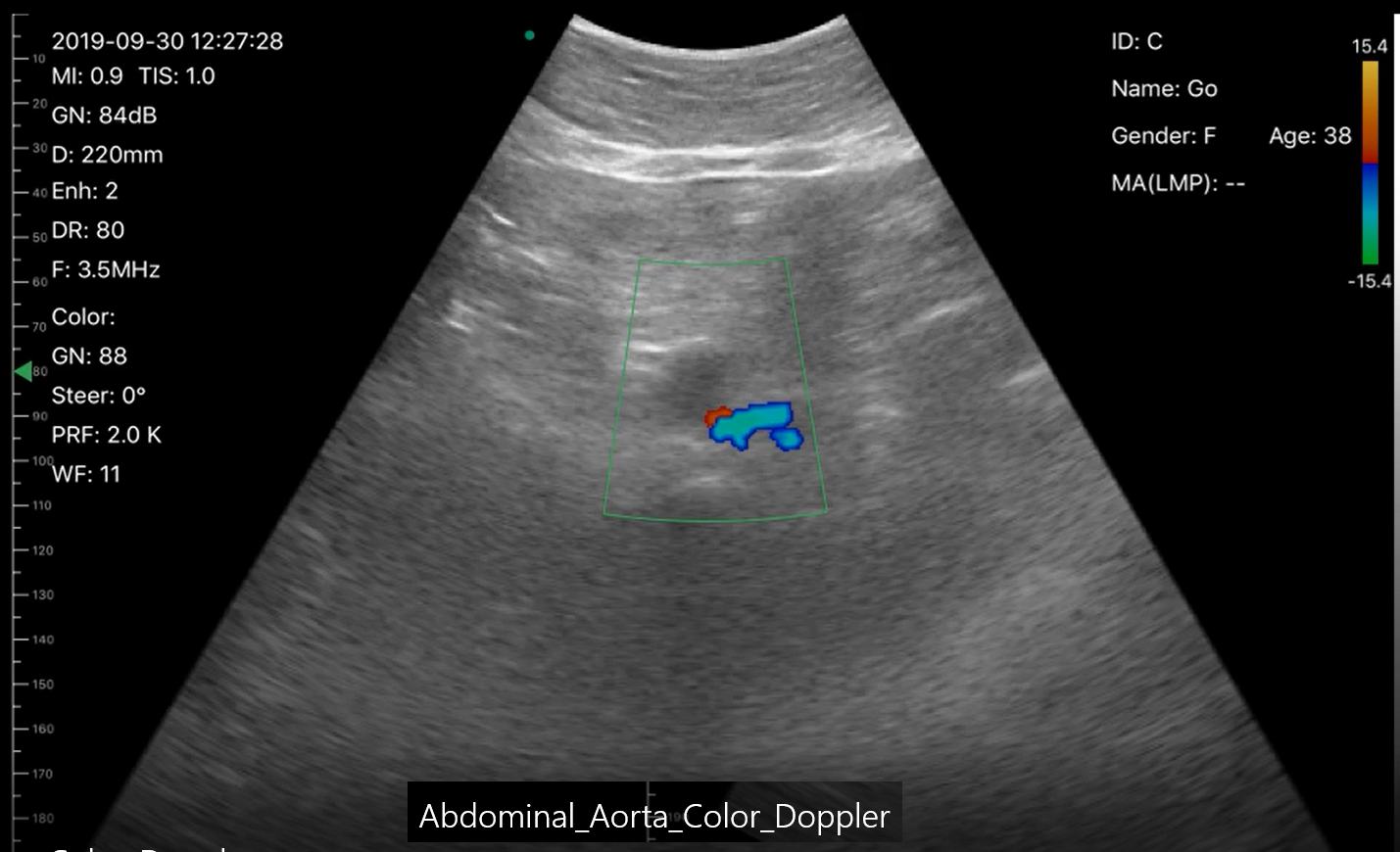 Abdominal Aorta Color Doppler