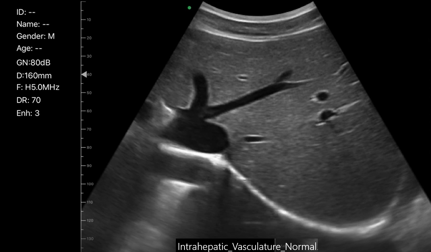 Intrahepatic Vasculature Normal
